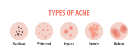 Types of acne diagram illustration vector on white background, Beauty concept.のイラスト素材