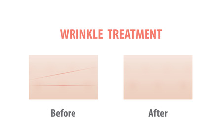 Wrinkle treatment comparison illustration vector on white background. Skin concept.のイラスト素材