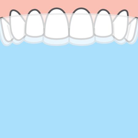Blank banner Upper Essix retainer illustration vector on blue background. Dental concept.
