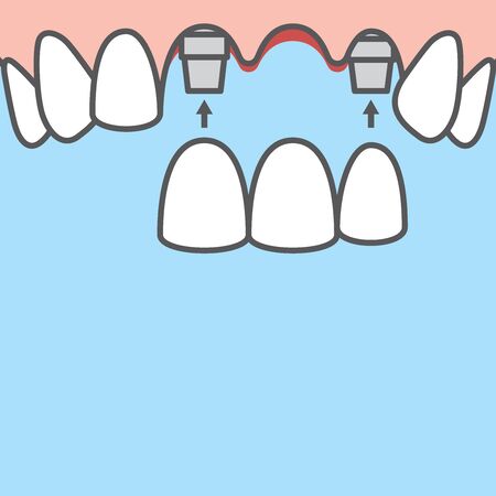 Blank banner Bridges teeth upper (implant) illustration vector on blue background. Dental concept.のイラスト素材