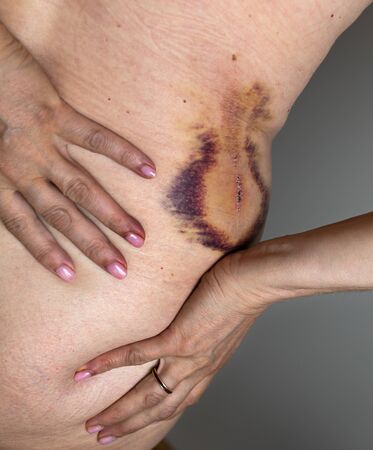 Large painful hematoma and trauma on the female torso. Bruise on the female stomach.の写真素材