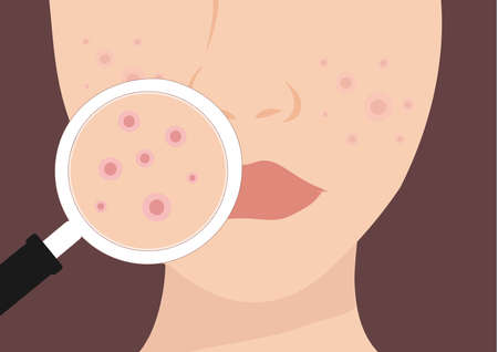 Young woman face with skin acne, pimples, blackheads vector illustration. Acne skin face problem...