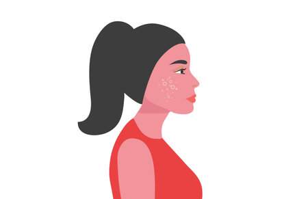 Young woman face with skin acne, pimples, blackheads vector illustration. Acne skin face problem conceptのイラスト素材