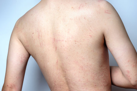 Man with dermatitis problem of rash, Allergy rash