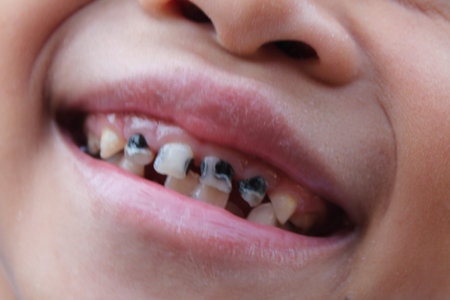 Little child with broken and rotten teeth  