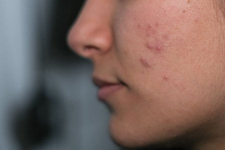 Young woman with skin acne face close up view,dermatological hormone diseaseの写真素材