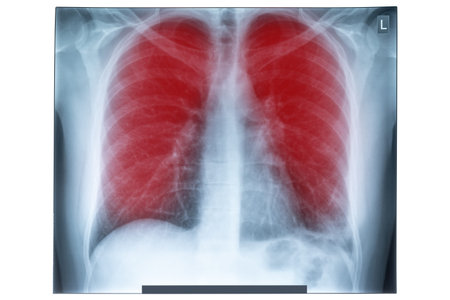 X-Ray image of human chest for a medical diagnostic. Epidemic virus 2019-nCoV Respiratory Syndrome....