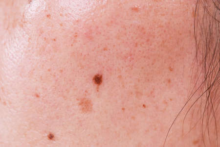 Problems with oily skin with freckles and dark spots Macro close-up of facial womanの写真素材