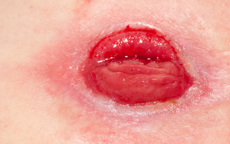 Exposed stoma of an intestinal ileostomyの写真素材