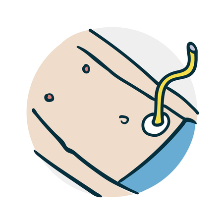 Special medical procedure on the intestineのイラスト素材