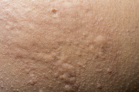 Close up of urticaria or allergy rashの写真素材
