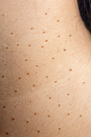 wart or dermatitis on women neck skinの写真素材