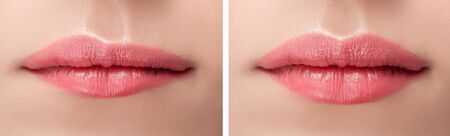 Before and after lips filler injections. Beauty plastic augmentation procedure.の写真素材