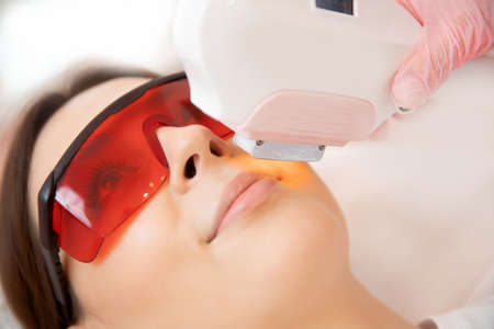 Removal of unwanted hair laser Epilation on face mustache young woman. Concept beauty and healthの写真素材