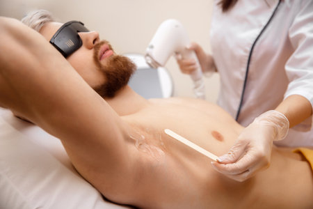 Closeup hair removal procedure from men armpit, laser epilation studioの写真素材