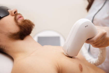 Laser depilation concept for men. Beauty salon worker applies treatment guy body hair removalの写真素材