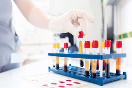 Lab worker preparing test blood for detection of antibodies and infections Corona virusの写真素材