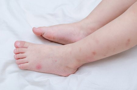 Mosquito bites sore on baby legsの写真素材