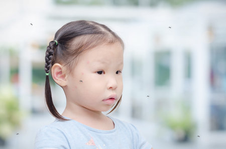 Little asian girl with red sport from mosquitoes bite on face