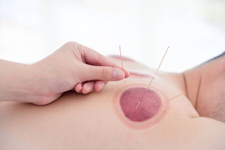 Closeup acupuncturist inserting needle on patient back ,alternative medicine concept.の写真素材