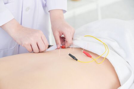 Close up of acupuncturist hands doing acupuncture with electrical stimulator at patient back ,Alternative medicine concept.の写真素材