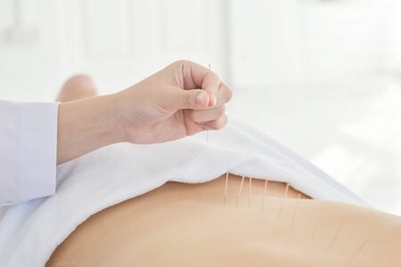 Close up of hands doing acupuncture with at patient back ,Alternative medicine concept.の写真素材