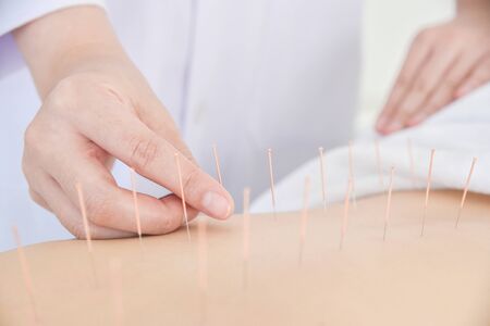 Close up of hands doing acupuncture with at patient back ,Alternative medicine concept.の写真素材