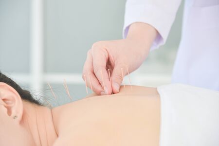 Hands of therapist doing acupuncture at patient back ,Alternative medicine concept.の写真素材