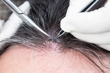 Closeup, doctor removing stitches from a healed wound on a man Â´s head, suture, forceps and scissorsの写真素材