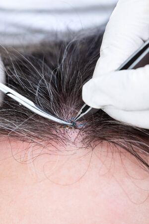 Doctor removing stitches with a pincette and scissors, wound suture on a man Â´s forehead, closeup