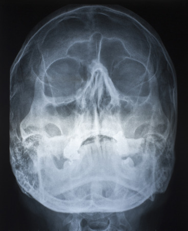 radio graphs skull, side frontal