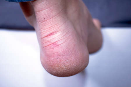 Dry skin on the feetの写真素材