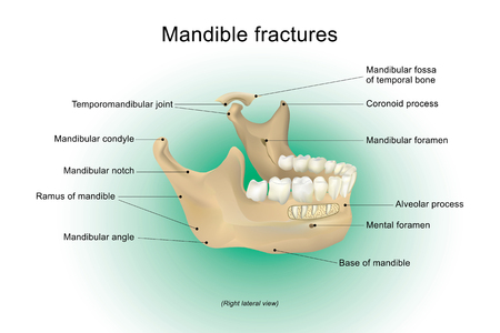 Mandible fractures is the largest, strongest and lowest bone in the face, Vector design, Arts, Illustration.の素材 [FY31070456494]