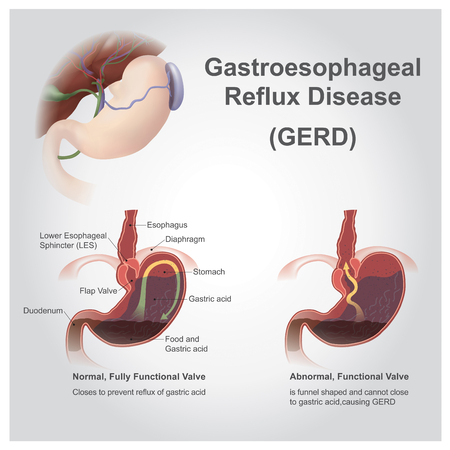 Gastroesophageal reflux disease (GERD), also known as acid reflux, is a long term condition where stomach contents come back up into the esophagus resulting in either symptoms or complications. Vector, Illustration.のイラスト素材