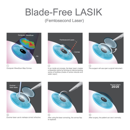 The method used by Blade-free LASIK lasers to create cornea flaps is claimed to enhance the safety of LASIK surgery.のイラスト素材