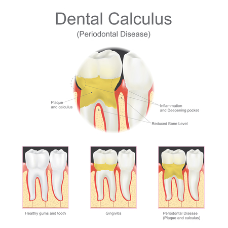 Dental calculus is the calcified plaque, or tartar, that is removed with a dental scalar during regular dentist visits. Vector graphic.のイラスト素材