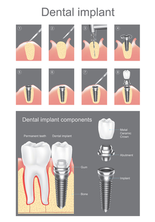 Dental implant is an artificial tooth root that is placed into your jaw to hold a replacement tooth or bridge. Dental implants may be an option for people who have lost a tooth or teeth due to periodontal disease, an injury, or some other reason. Vector gのイラスト素材