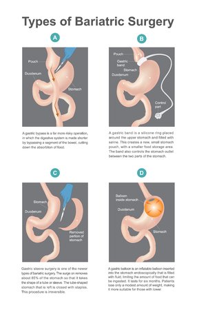 A new types of Bariatric surgery result in patients lose only of weightのイラスト素材
