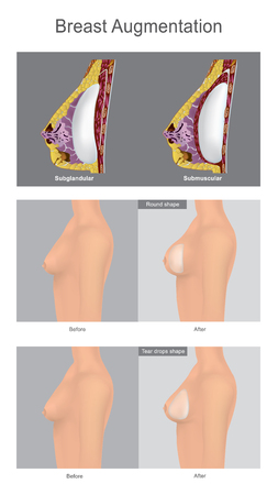 The Surgery Augmentation of the breast  using filled with saline-solution.
This is popular cosmetic surgery for women. Illustration anatomy body part.のイラスト素材