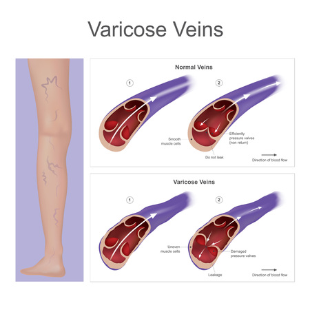 Vein pressure have become enlarged and twisted on the leg, result from damaged blood pressure valves. Illustration.のイラスト素材