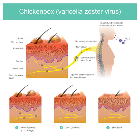 Illustration of a painful condition caused by nerve damage that was caused by the inhalation of varicella virus in aerosol.のイラスト素材