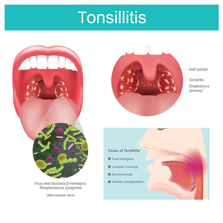Inflammation of the soft tissue in the mouth and pain in swallowing occurs.&#xA;Caused by streptococcus bacterial infection including some viruses that causes redness and swelling in the throat and tonsils Pain in swallowing. Illustration.のイラスト素材
