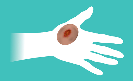The hands that get hurt by the wound. Illustration info graphic.のイラスト素材