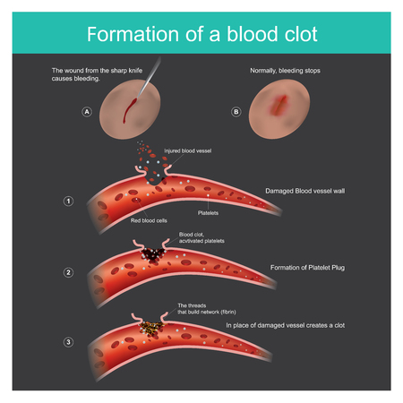 The wound from the sharp knife on skin Slightly bleeding, The body can respond to stop blood out flow from the capillaries, And anti-bacterial through the body.のイラスト素材