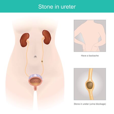 The illustrate explain cause of backache and abdomen pain from ureter blockage, affecting to the nerves. 3D Illustration anatomy human body.のイラスト素材