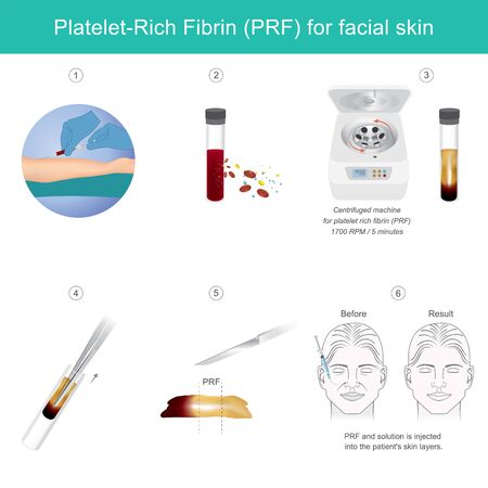 Platelet rich fibrin for facial skin. Illustration explain Technology treatment medical facial skin from stem cells for make anti-aging serum.のイラスト素材