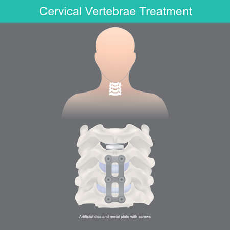 Illustration pour Cervical Vertebrae Treatment. Neck bone anatomy and artificial disc replacement. - image libre de droit