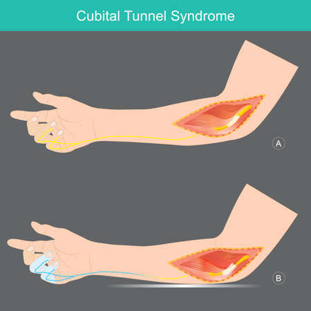 Cubital Tunnel Syndrome. A condition that involves pressure or stretching of the ulnar nerve in arms which can cause numbness or tingling in the ring and small fingers.のイラスト素材