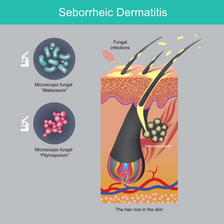 Seborrheic Dermatitis. Scalp fall of sheets problem caused by sebaceous glands in hair roots skin and fungi on scalp.のイラスト素材