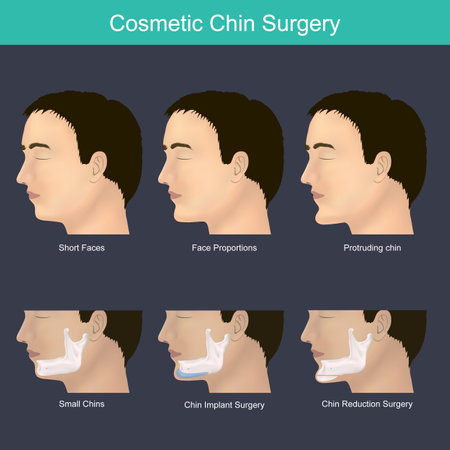 Cosmetic Chin Implant Surgery. Illustration of the chin and jaw.のイラスト素材